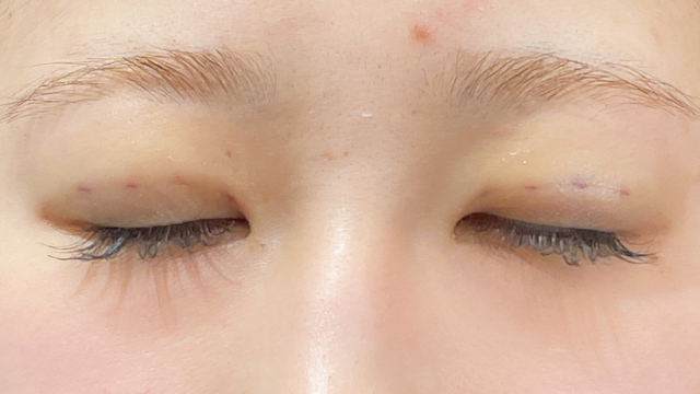 Postoperative Condition Part 1