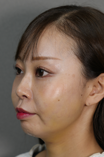 手術前の状態 その1