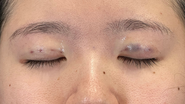 Postoperative Condition Part 1