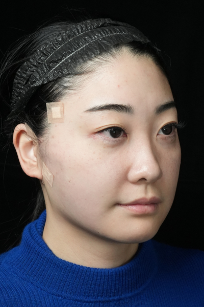 手術前の状態 その1