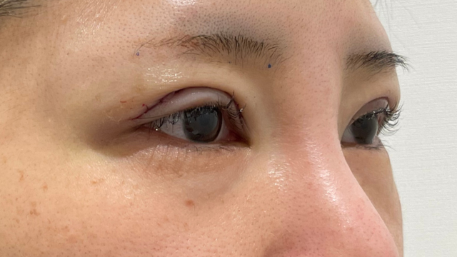 Postoperative Condition Part 1