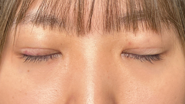 Postoperative Condition Part 1