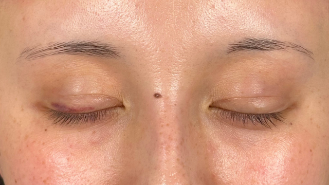 Postoperative Condition Part 1