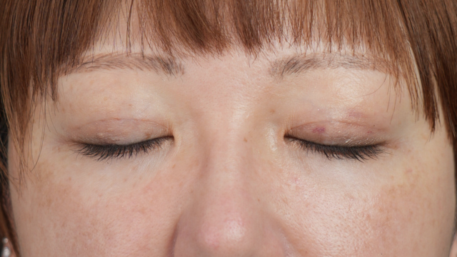 Postoperative Condition Part 1