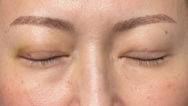 Postoperative Condition Part 1