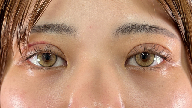 Postoperative Condition Part 1