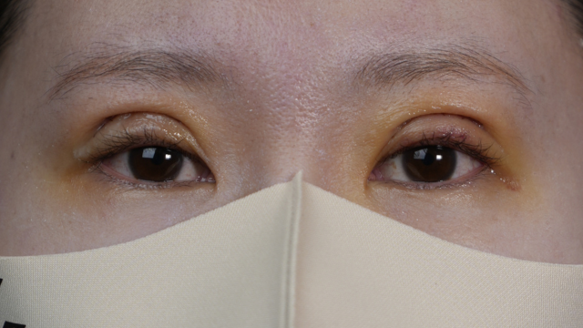 Postoperative Condition Part 1