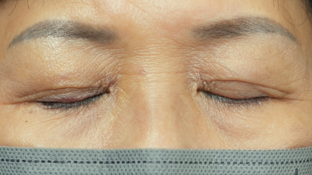 Postoperative Condition Part 1