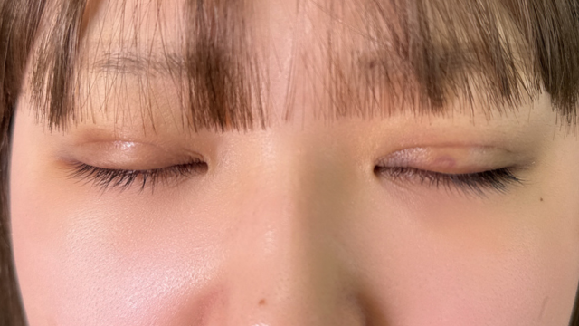 Postoperative Condition Part 1