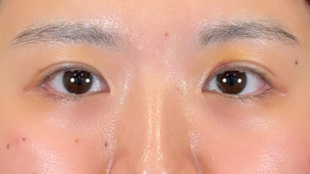 Postoperative Condition Part 1