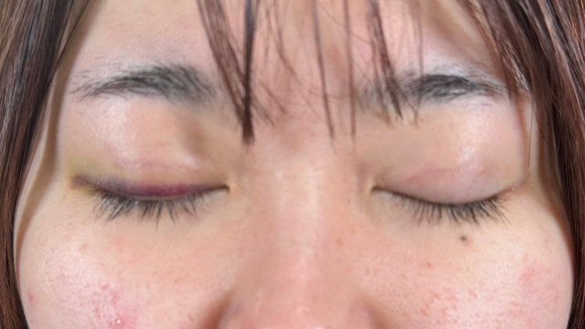 Postoperative Condition Part 1