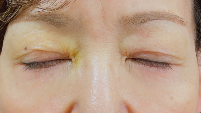 Postoperative Condition Part 1