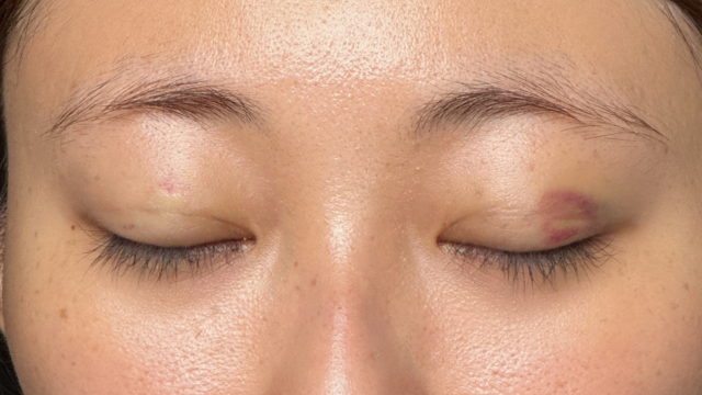 Postoperative Condition Part 1