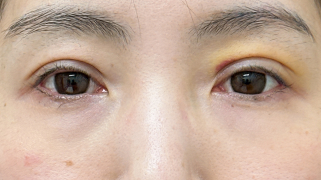 Postoperative Condition Part 1