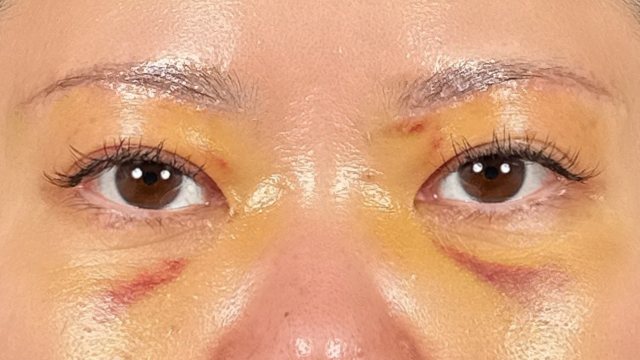 Postoperative Condition Part 1