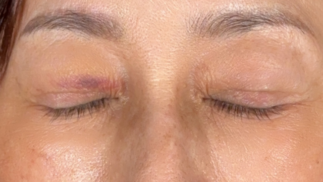 Postoperative Condition Part 1