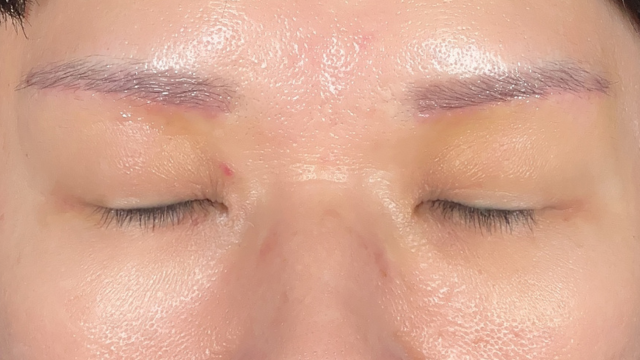 Postoperative Condition Part 1