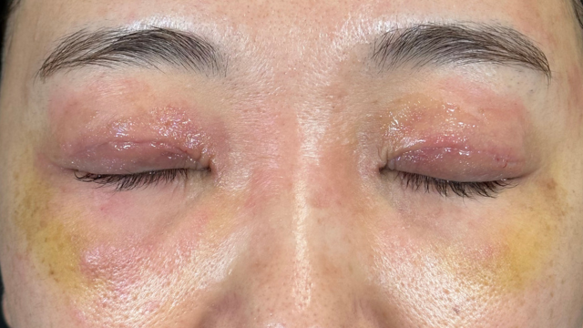 手術前の状態 その1