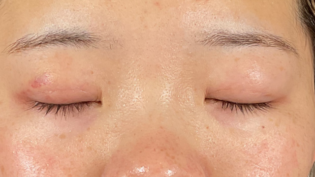 Postoperative Condition Part 1