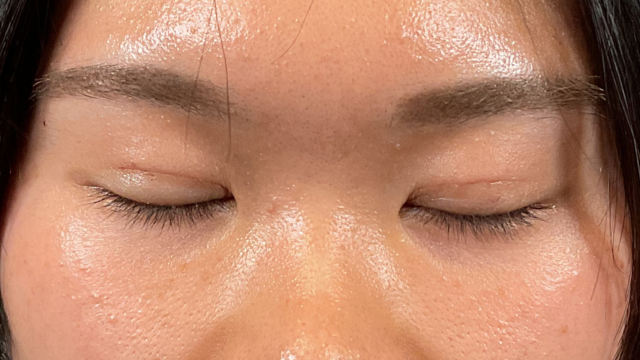 Postoperative Condition Part 1