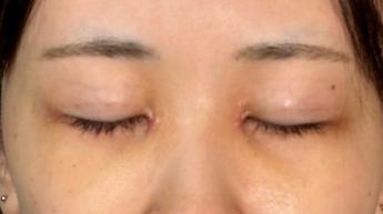 Postoperative Condition Part 1