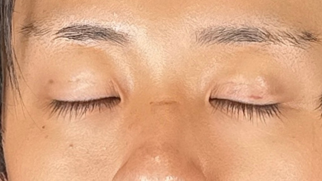 Postoperative Condition Part 1