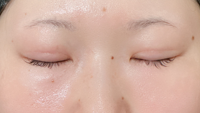 Postoperative Condition Part 1