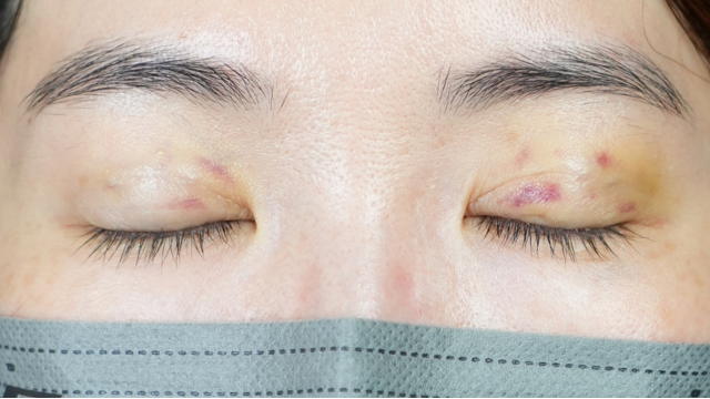 Postoperative Condition Part 1