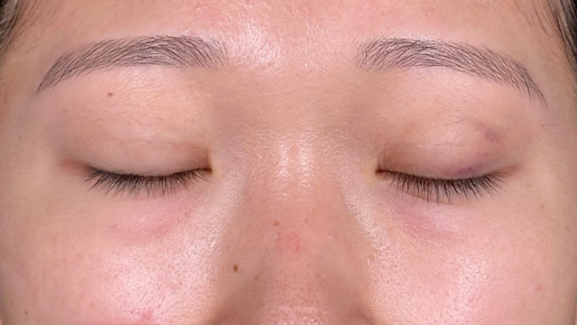 Postoperative Condition Part 1