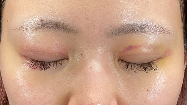 Postoperative Condition Part 1