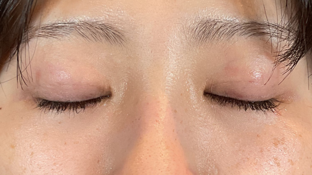 Postoperative Condition Part 1