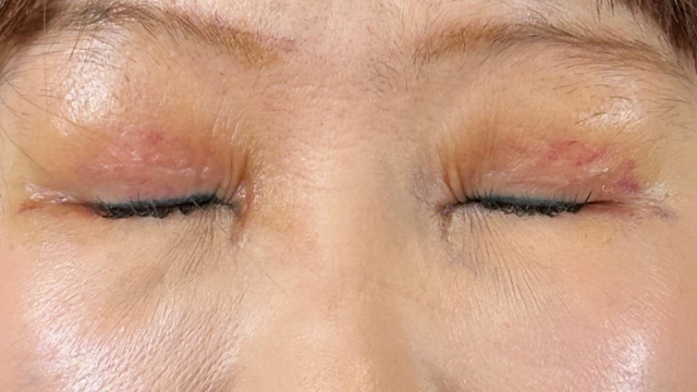 Postoperative Condition Part 1