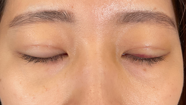 Postoperative Condition Part 1