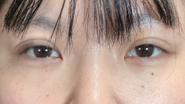 Postoperative Condition Part 1