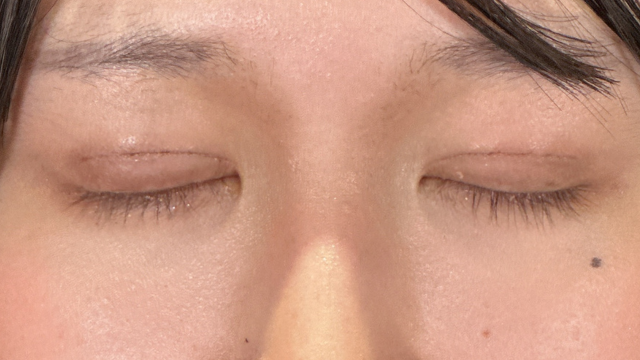 Postoperative Condition Part 1