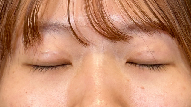 手术前的状态 其一