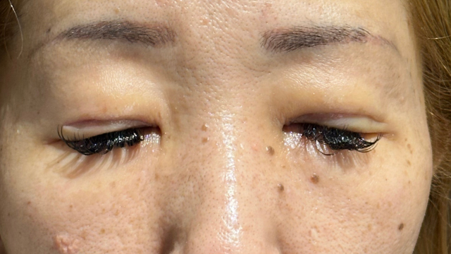 手术前的状态 其一