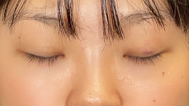 Postoperative Condition Part 1