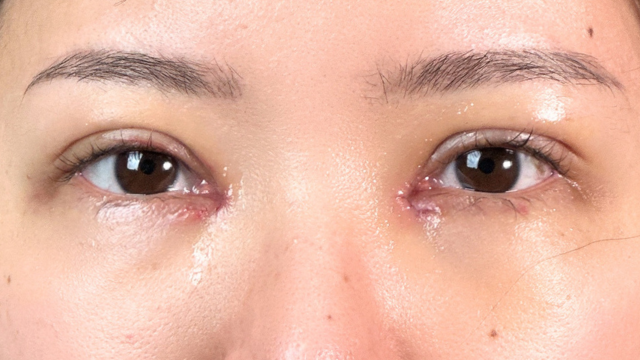 Postoperative Condition Part 1