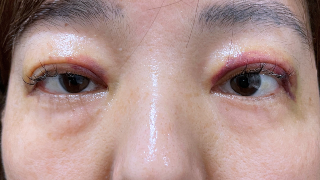 Postoperative Condition Part 1