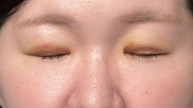 Postoperative Condition Part 1