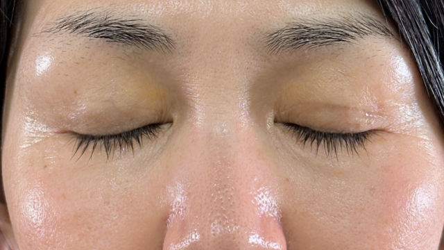 Postoperative Condition Part 1