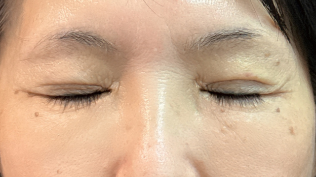 Postoperative Condition Part 1