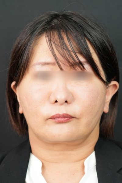 手術前の状態 その1