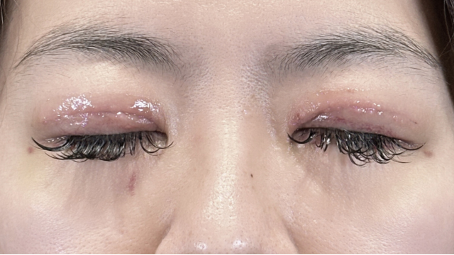 Postoperative Condition Part 1