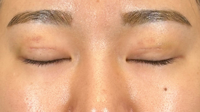 Postoperative Condition Part 1