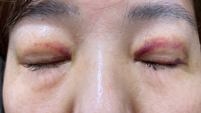 Postoperative Condition Part 1