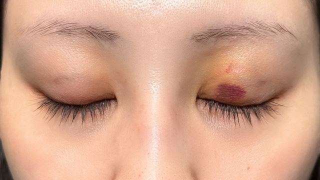 Postoperative Condition Part 1