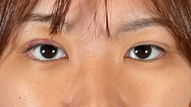 Postoperative Condition Part 1