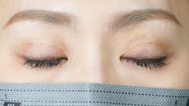 Postoperative Condition Part 1